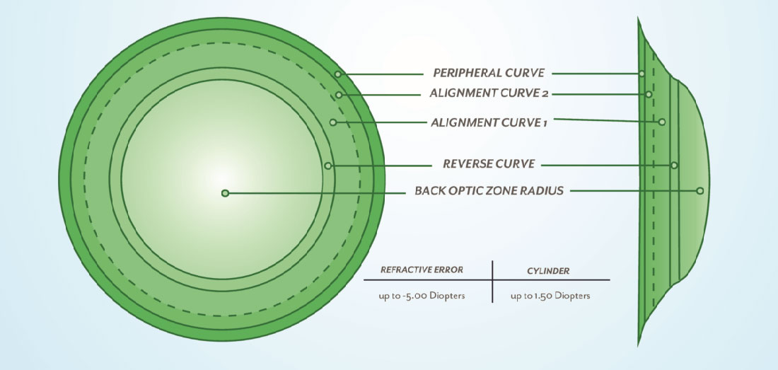 オルソケラトロジー